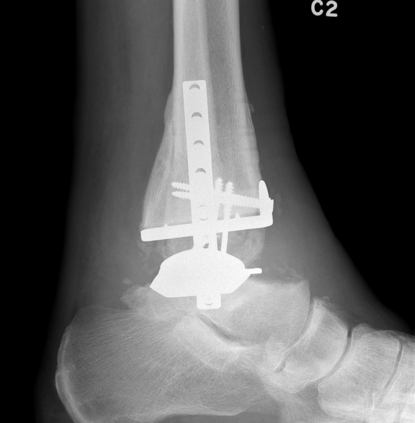 Ankle Arthroplasty post ORIF lateral